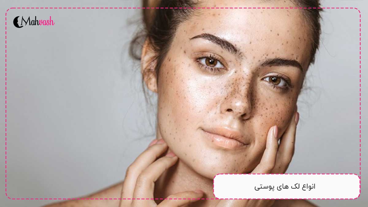 10 روش درمان لک های پوستی